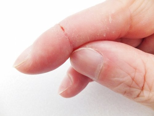 ゴワゴワ乾燥肌対策とアトピーのケア方法